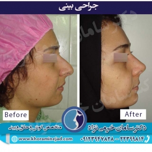 تاثیرات فرم بینی در عمل جراحی