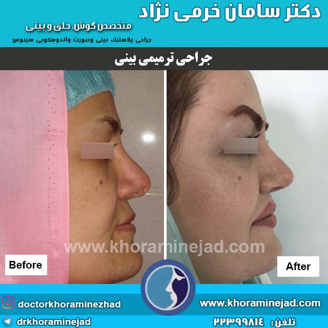 عمل ترمیم بینس طبیعی