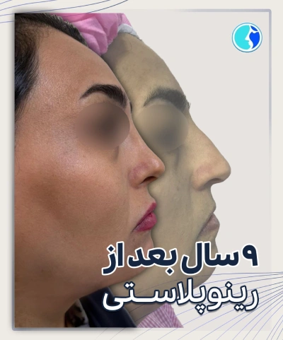قبل و بعد جراحی بینی استخوانی
