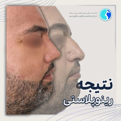 رضایت جراحی بینی استخوانی