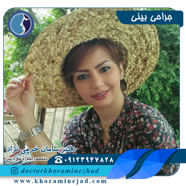 سوالات متداول جراحی بینی چیست