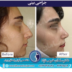 علائم شکستگی بینی