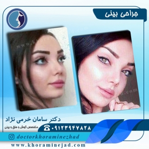 آبریزش بینی بعد از عمل بینی