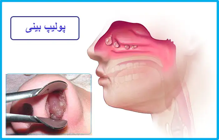 پولیپ بینی