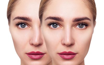 آیا انحراف بینی با کجی بینی فرق دارد؟