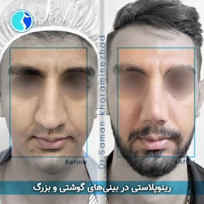 عکس عمل بینی گوشتی مردانه