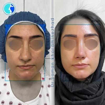 نمونه‌کار عمل جراحی بینی توسط دکتر خرمی نژاد