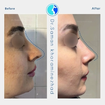 نمونه کار جراحی بینی طبیعی