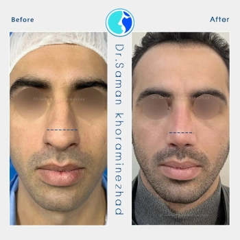 نمونه جراحی بینی طبیعی مردانه