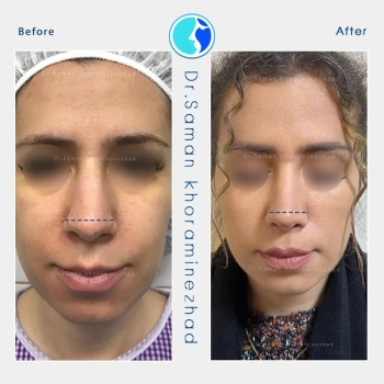 جراحی بینی طبیعی