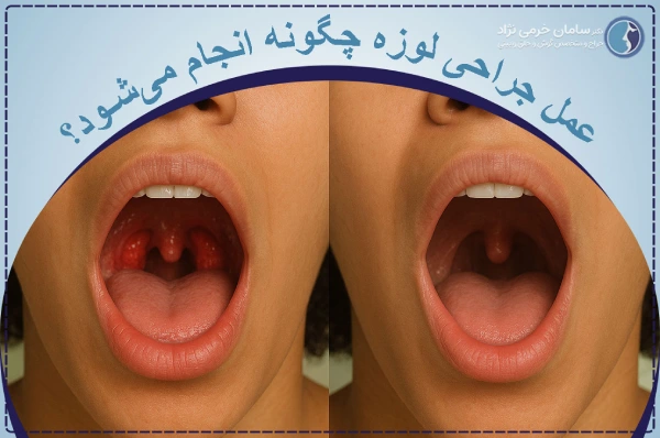 عمل جراحی لوزه چگونه انجام میشود؟