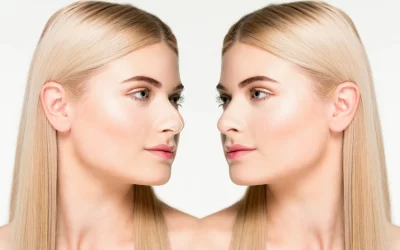 جراحی بینی طبیعی: حفظ تناسب و زیبایی چهره