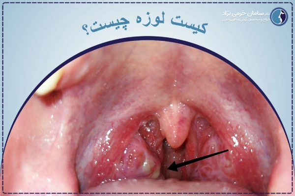 کیست لوزه