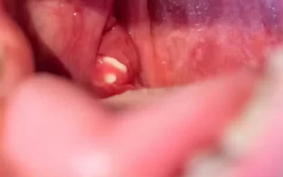 درمان قطعی سنگ لوزه؛ راهکارهای پزشکی و خانگی