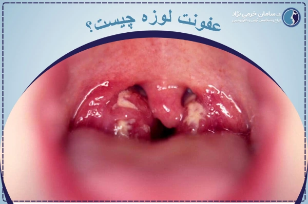 عفونت لوزه