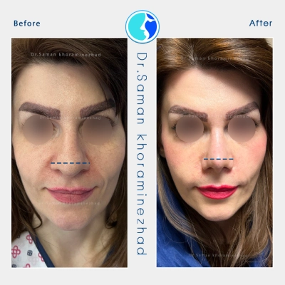 عمل بینی گوشتی زنانه