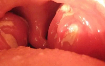 آبسه لوزه؛ از علائم اولیه تا درمان قطعی